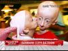 Sindromul Progeria - o boala cumplita si rara transforma copii de 10 ani in batrani de 70 de ani! VIDEO