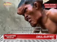 Omul Elefant - chinuit de o anomalie genetica greu de definit, refuza operatia, considerand ca e victima unui blestem - VIDEO