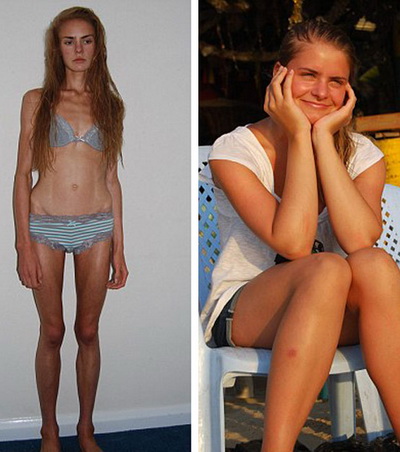  Ai grija ce dieta tii! O adolescenta de 16 ani a murit din cauza anorexiei!