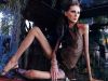 ANOREXIA - boala moderna care te poate baga in mormant - VIDEO