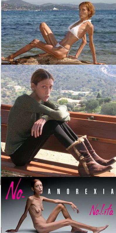 Socant! Un model francez a murit la 28 de ani din cauza anorexiei!