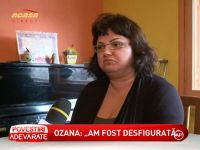 Ozana Barabancea desfigurata de un tratament cosmetic - VIDEO