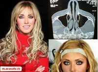 Anahi a suferit o interventie chirurgicala la nas  - VIDEO