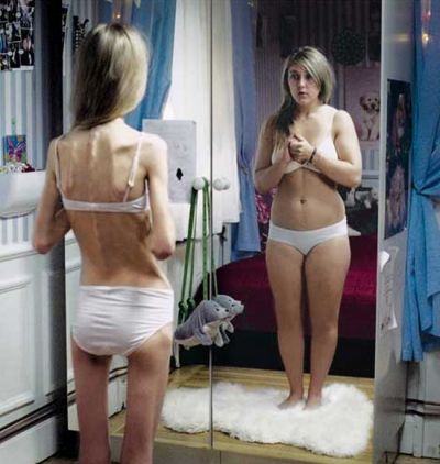 Anorexia nu-i iarta nici pe copii: Ana are 13 ani, e piele si os, dar se vede obeza. Afla povestea ei!