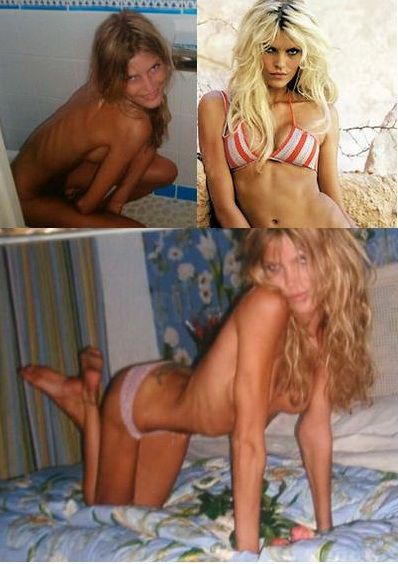 Anorexia loveste din nou -  Din model sexy a ajuns piele si os - GALERIE FOTO