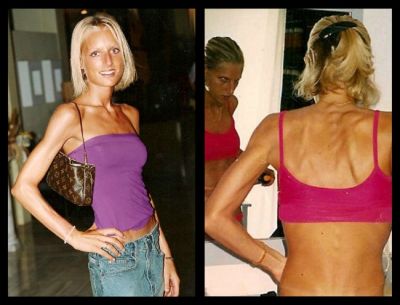 	Manca numai bomboane mentolate si cantarea doar 25 kg! Cum a reusit un fost model sa invinga anorexia