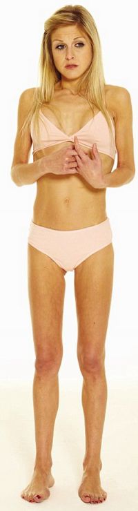 Cosmarul unei anorexice: Nu are menstruatie si se simte vinovata cand mananca - FOTO