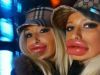 Cum au ajuns femeile sa se mutileze din dorinta de a avea buze mai mari - FOTO& VIDEO