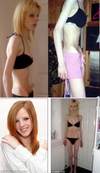 Avea 30 de kilograme si manca numai bomboane fara zahar -  Povestea unei tinere care a invins anorexia - FOTO