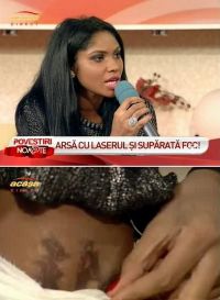 Vezi ranile lui Laurette dupa tratamentul de infrumusetare - FOTO&VIDEO