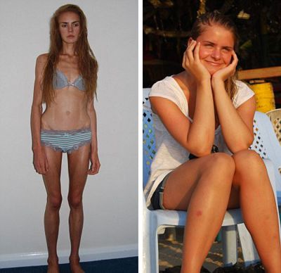 Ai grija ce dieta tii! O adolescenta de 16 ani a murit din cauza anorexiei!