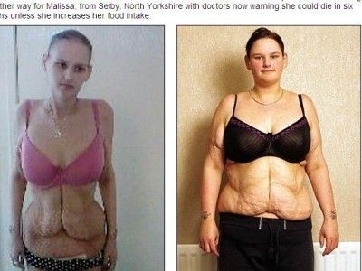 A fost cea mai grasa fata din Anglia. Acum e ANOREXICA. Fotografii socante