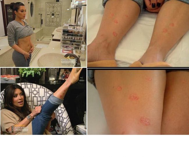 Adio celebritate? Kim Kardashian a fost diagnosticata cu o boala grava de piele!