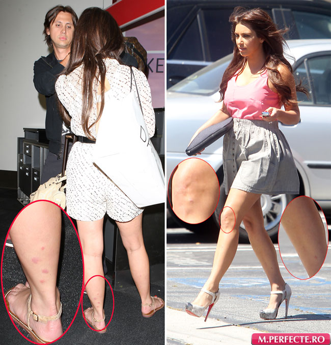 Kim Kardashian nu se lasa invinsa de boala de piele: poarta in continuare fuste scurte! FOTO