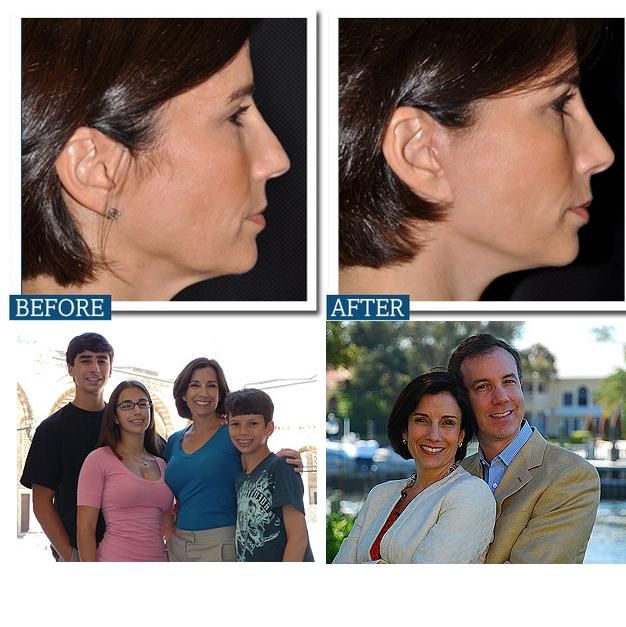 Familie de medici esteticieni: Ne injectam Botox unul altuia in pauza de pranz